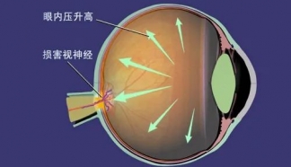 叮咚！您有一份關于青光眼的全解指南，請注意及時查收！